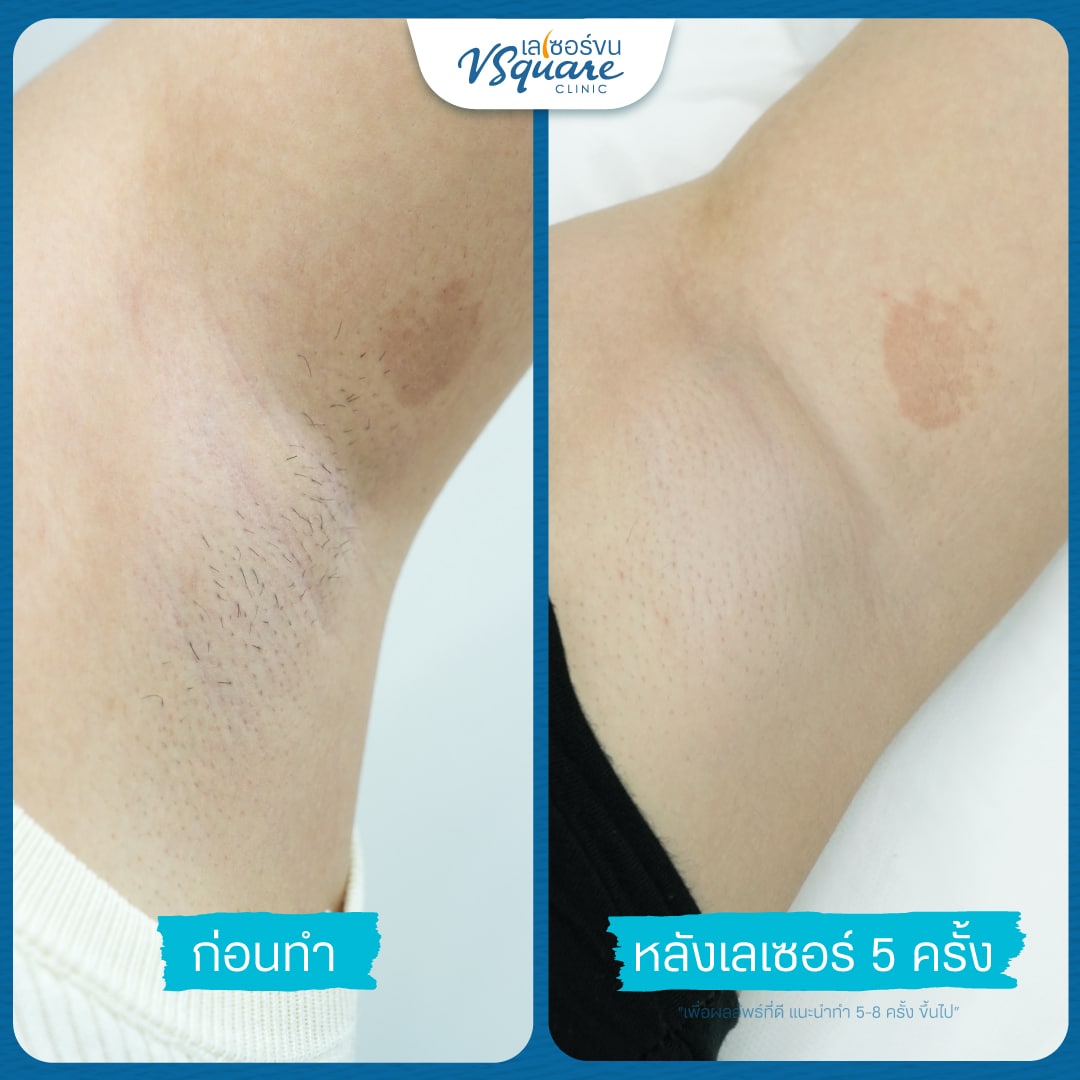 รีวิวเลเซอร์ขนรักแร้