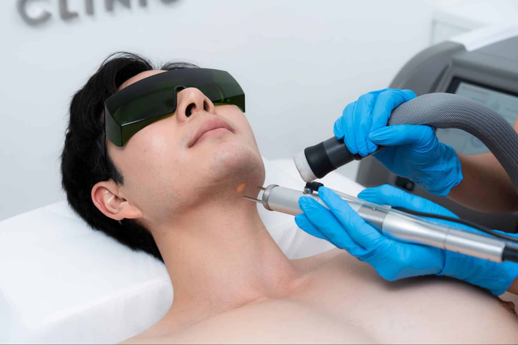 ขั้นตอนเลเซอร์หนวด