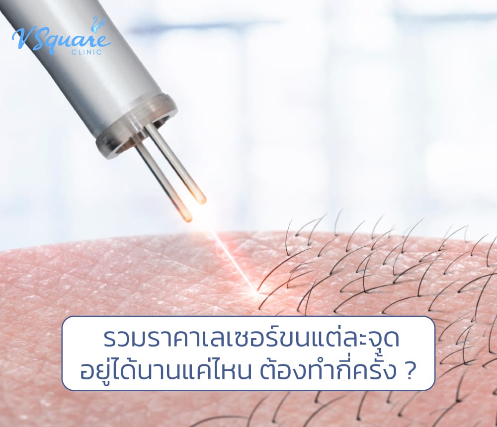 เลเซอร์ขนราคา