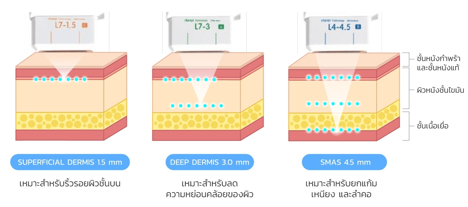 หัว Ulthera