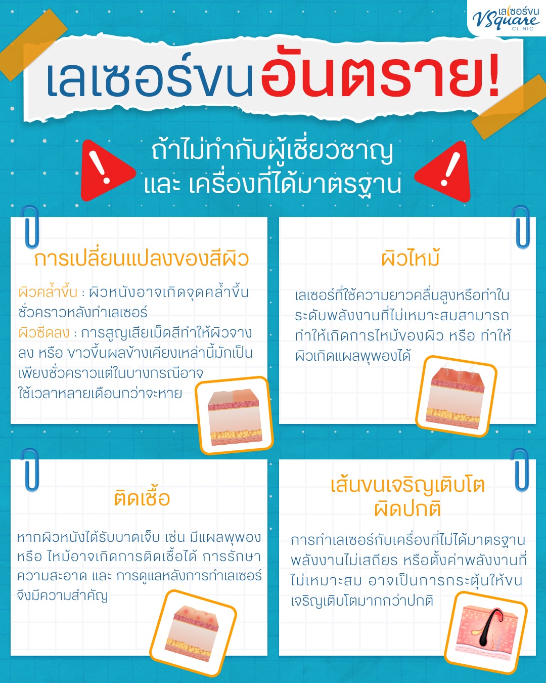 เลเซอร์หนวด อันตรายไหม