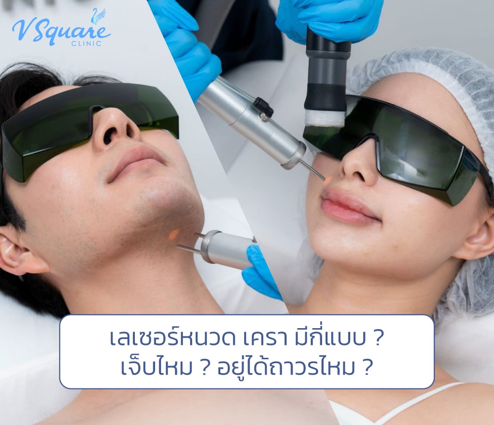 เลเซอร์หนวด