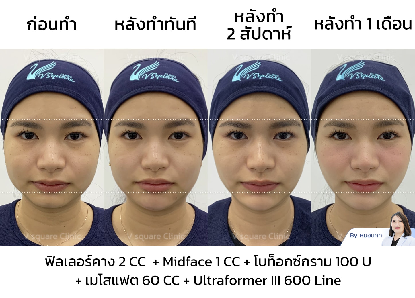 hifu รีวิว
