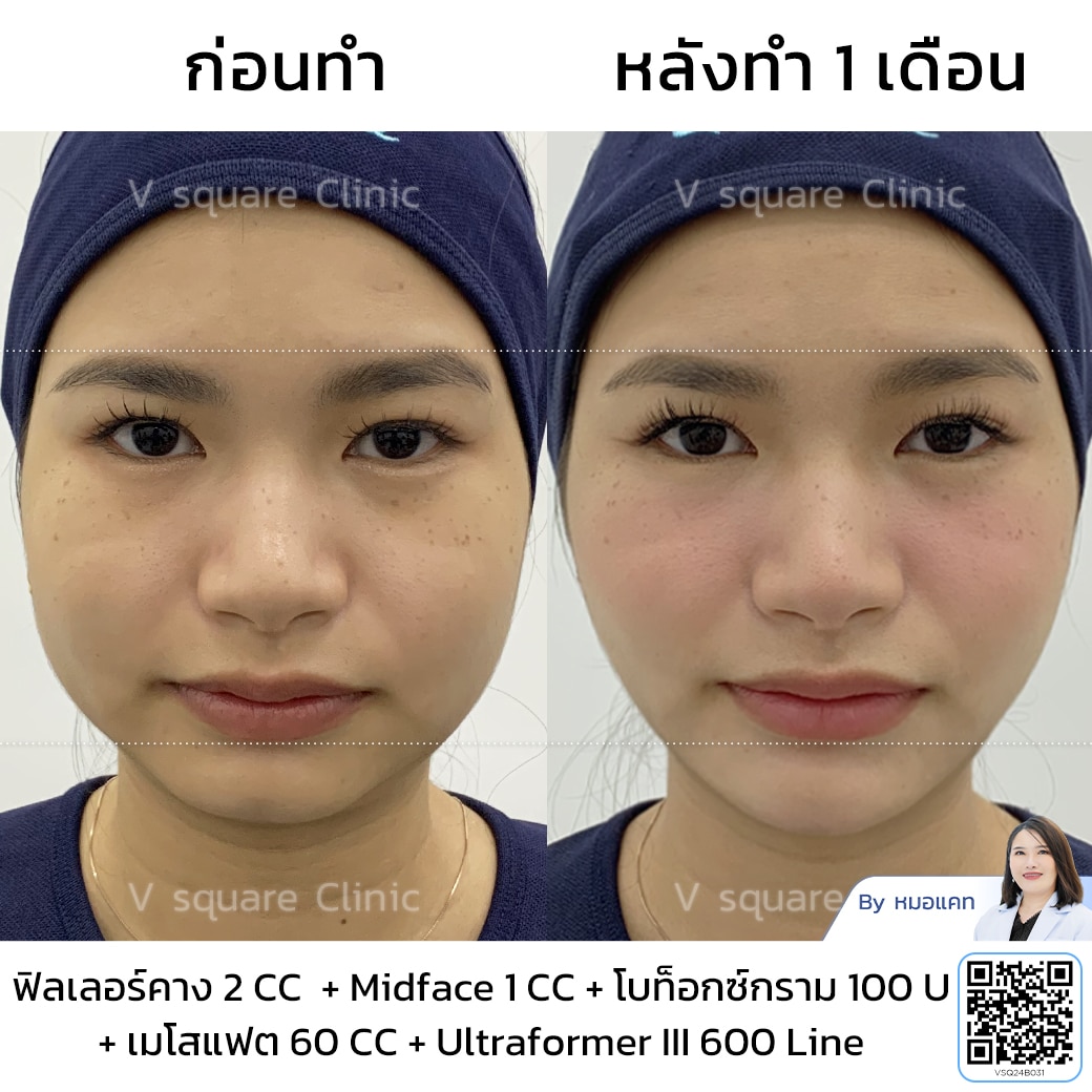 ultraformer III รีวิว_คุณเนย โดยหมอแคท