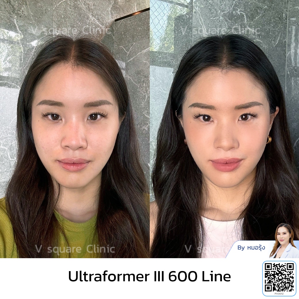 รีวิว Ultraformer III_คุณแน้น Influencer โดยหมอ รุ้ง
