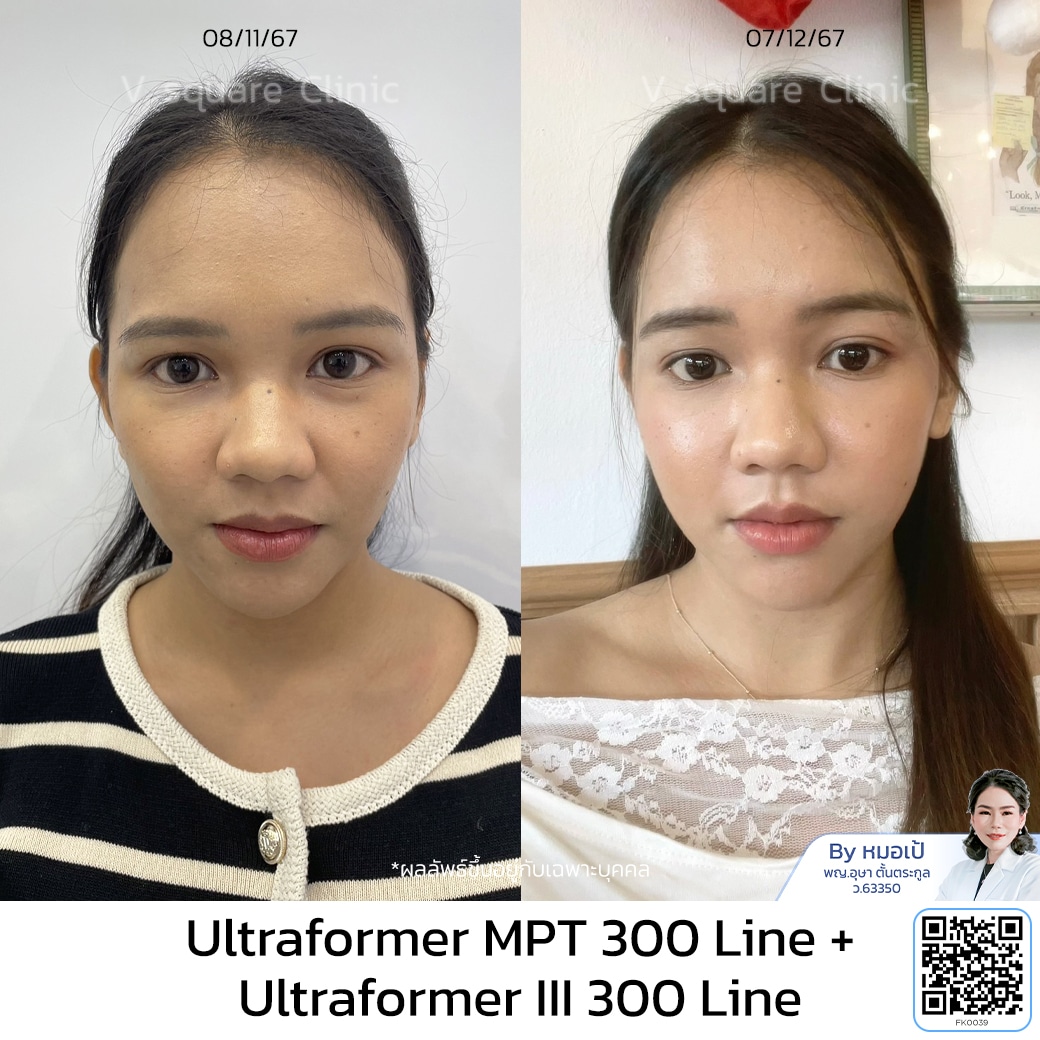 รีวิว Ultraformer III_มายด์ โดย หมอเป้