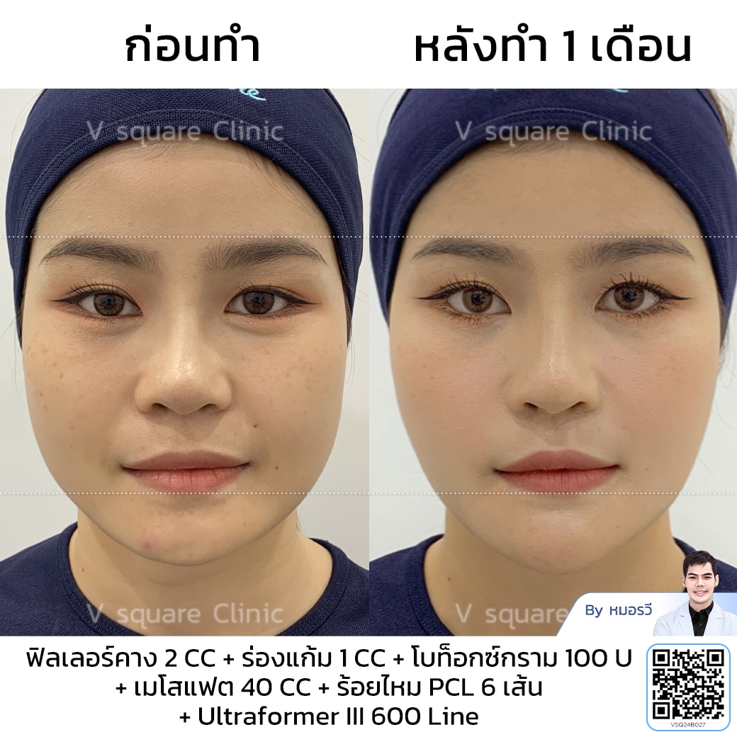 รีวิวทำ Hifu ultraformer III_คุณหญิง โดยหมอรวี