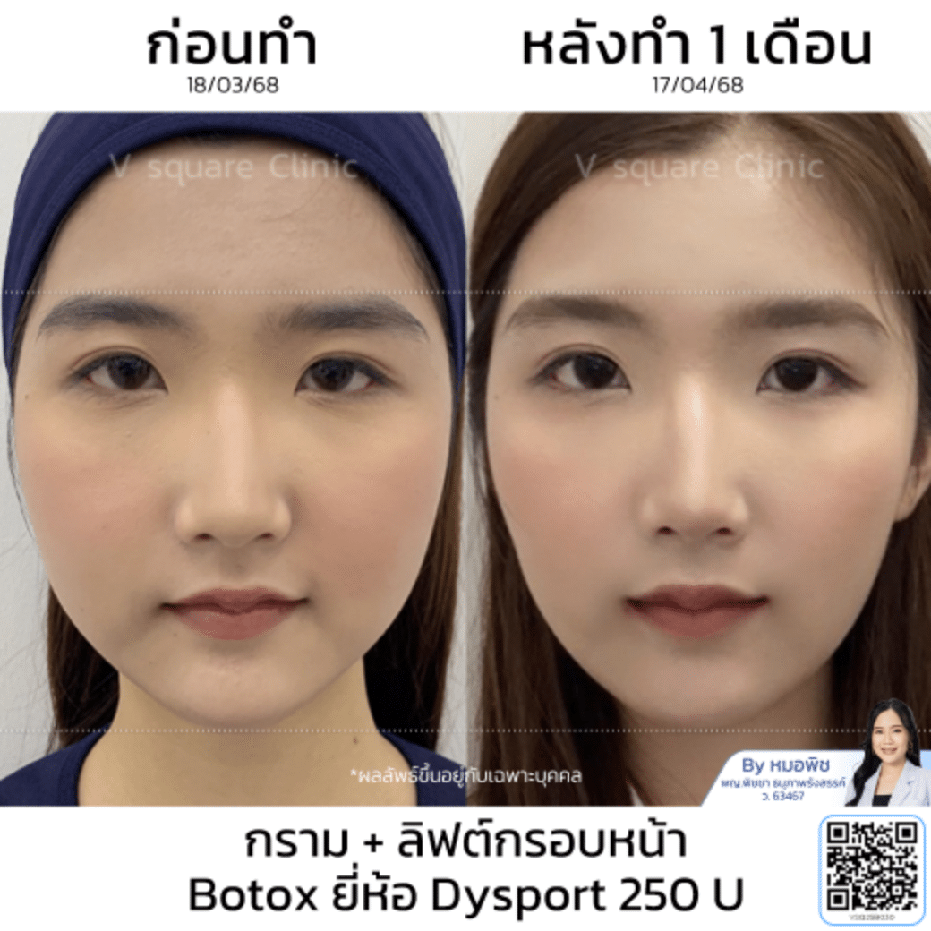 รีวิวลิฟกรอบหน้า_คุณคาโอริ