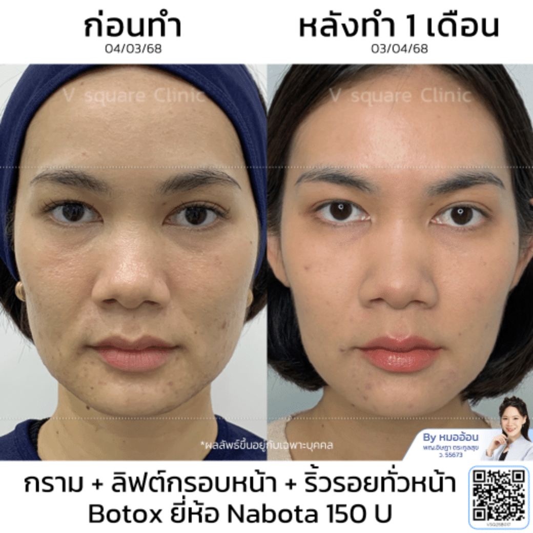 รีวิวลิฟกรอบหน้า_คุณน้ำ
