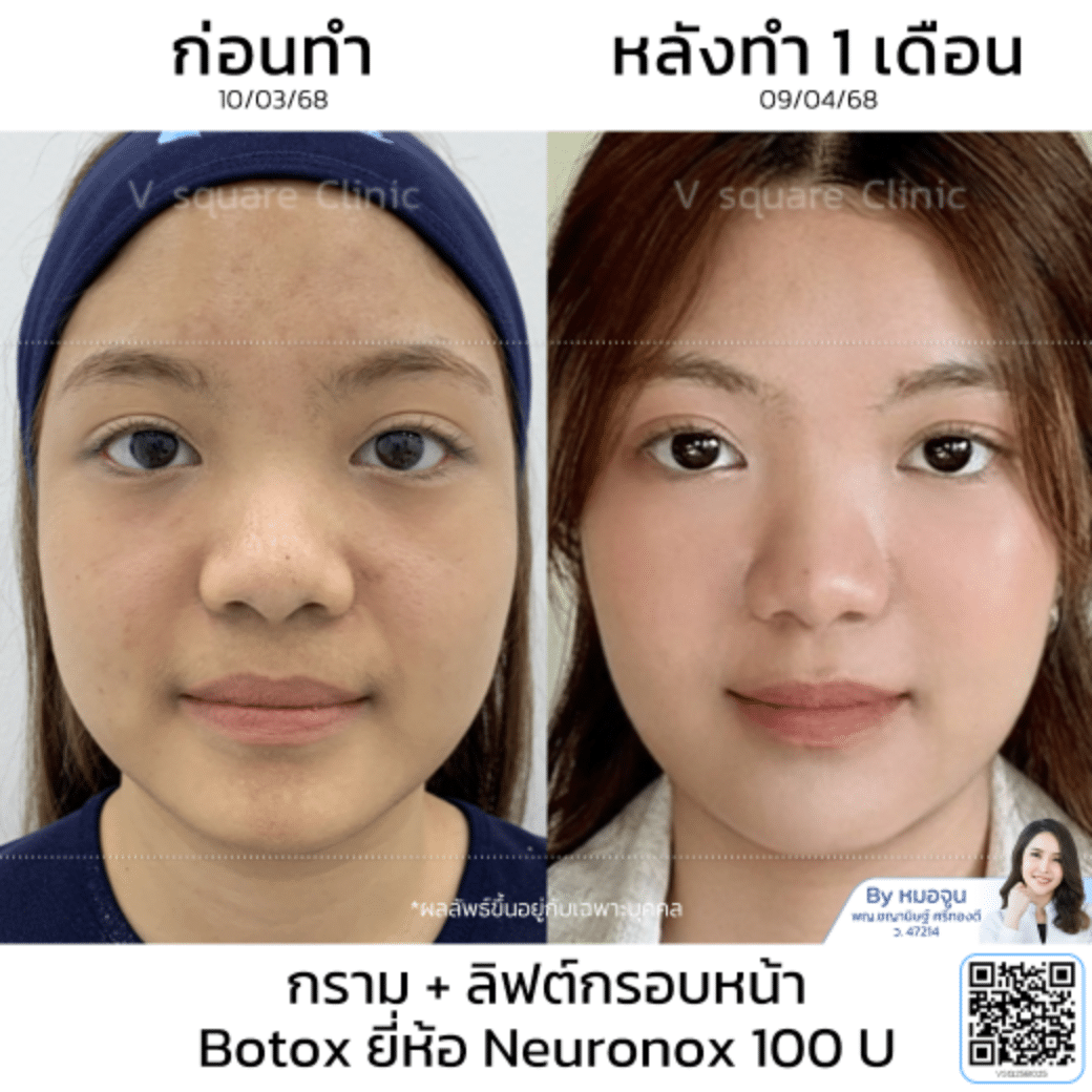 รีวิวลิฟกรอบหน้า_คุณฟา
