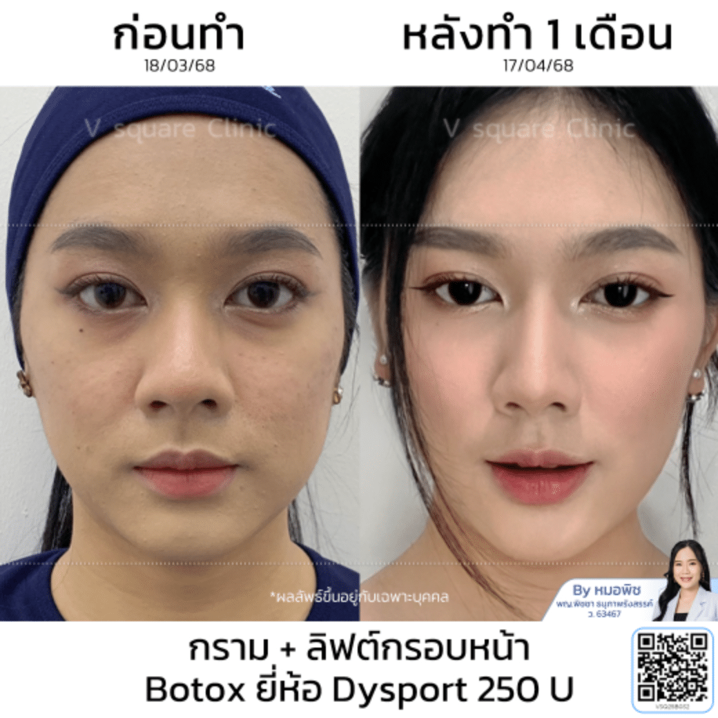 รีวิวลิฟกรอบหน้า_คุณยาหยี