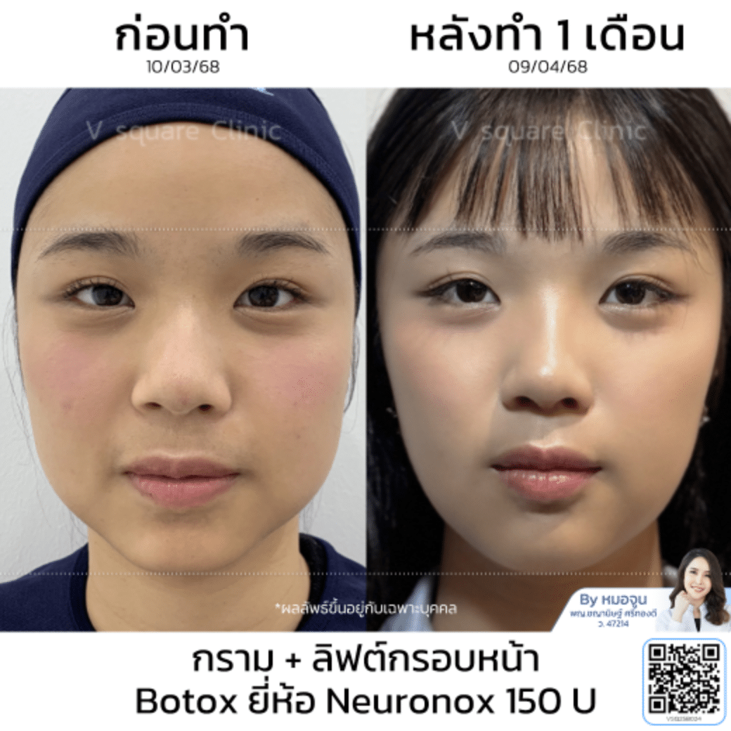 รีวิวลิฟกรอบหน้า_คุณอะตอม