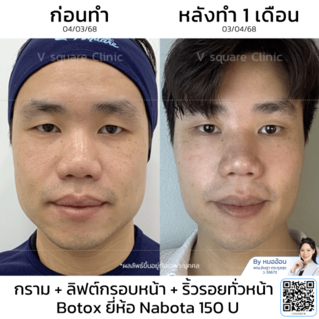 รีวิวลิฟกรอบหน้า_คุณเต้