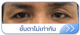 Thermage ชั้นตาไม่เท่ากัน