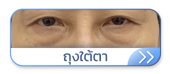 Thermage ถุงใต้ตา