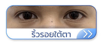 Thermage ริ้วรอยใต้ตา