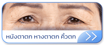 Thermage หนังตาตก