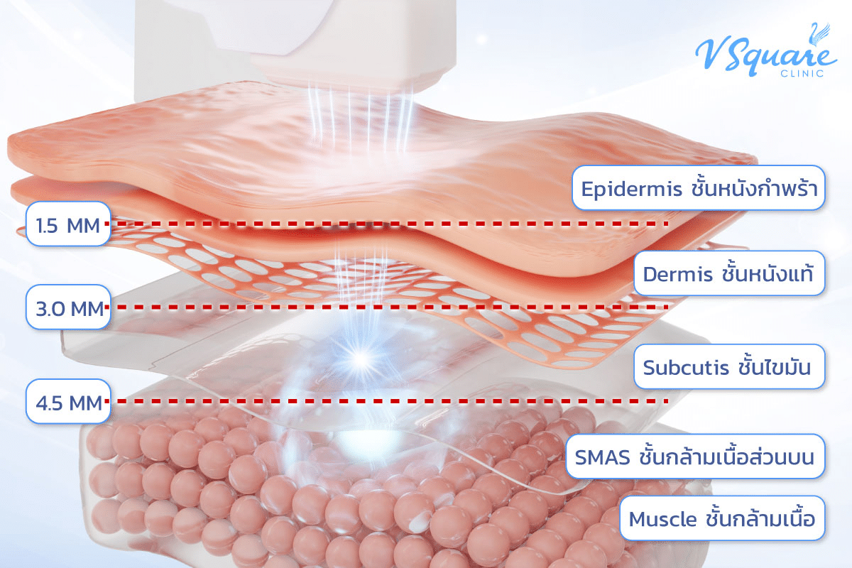 Ulthera หน้าบวม จากพลังงานความร้อน