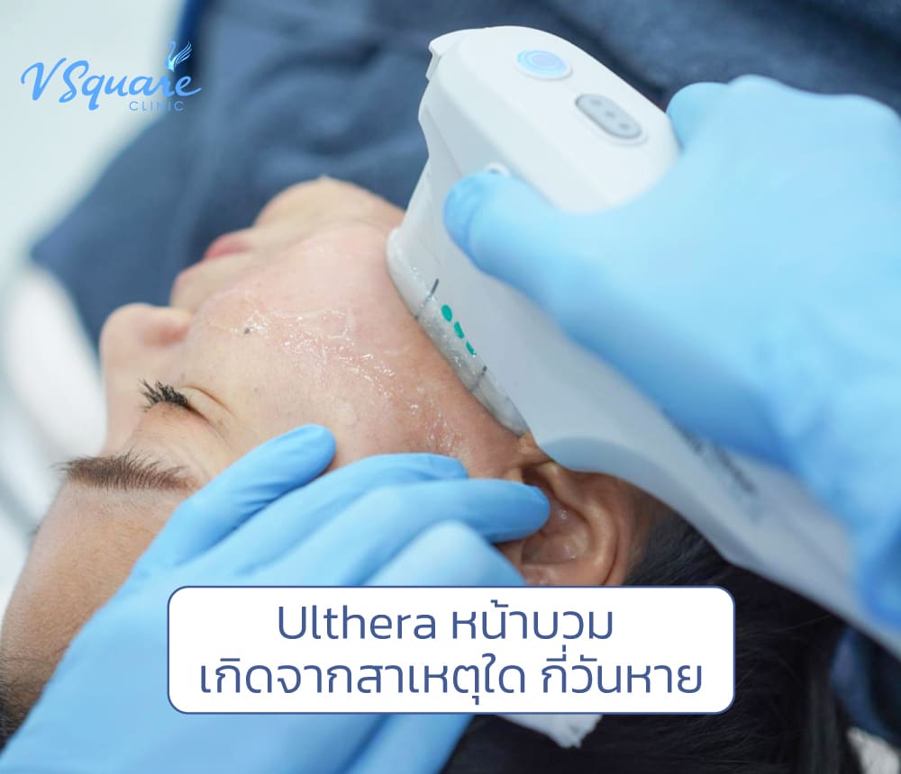 Ulthera หน้าบวม