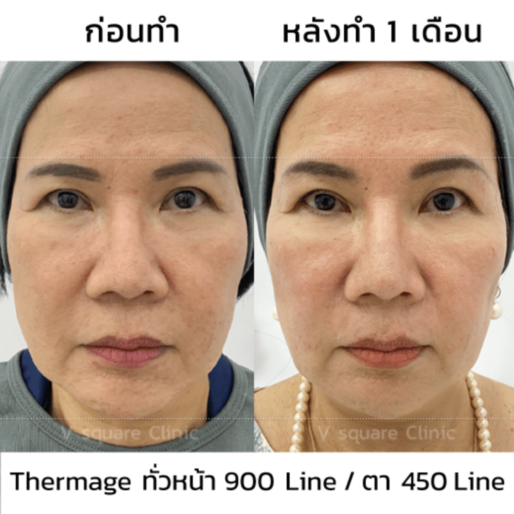 รีวิว Thermage ใต้ตา