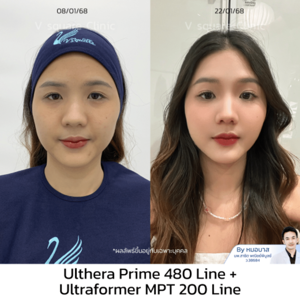 รีวิว ulthera ลดริ้วรอยร่องแก้มลึก_เอิร์น UL RR+MPT