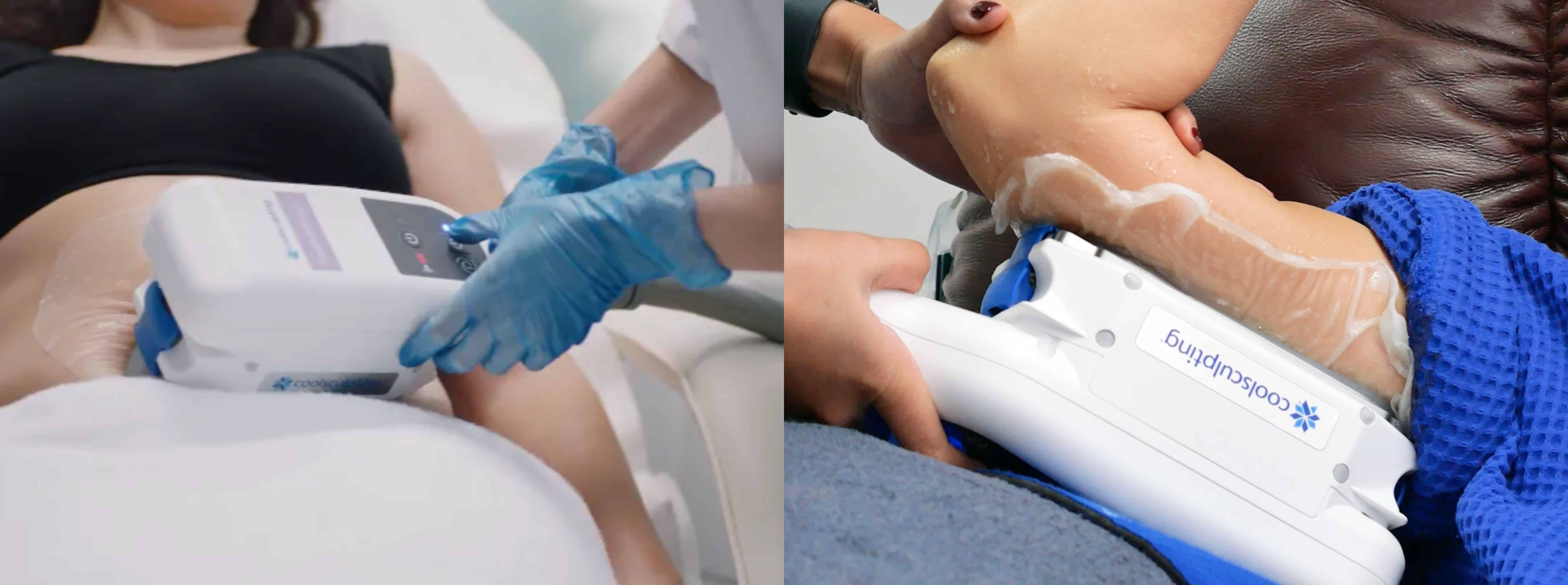 Coolsculpting กำจัดไขมัน