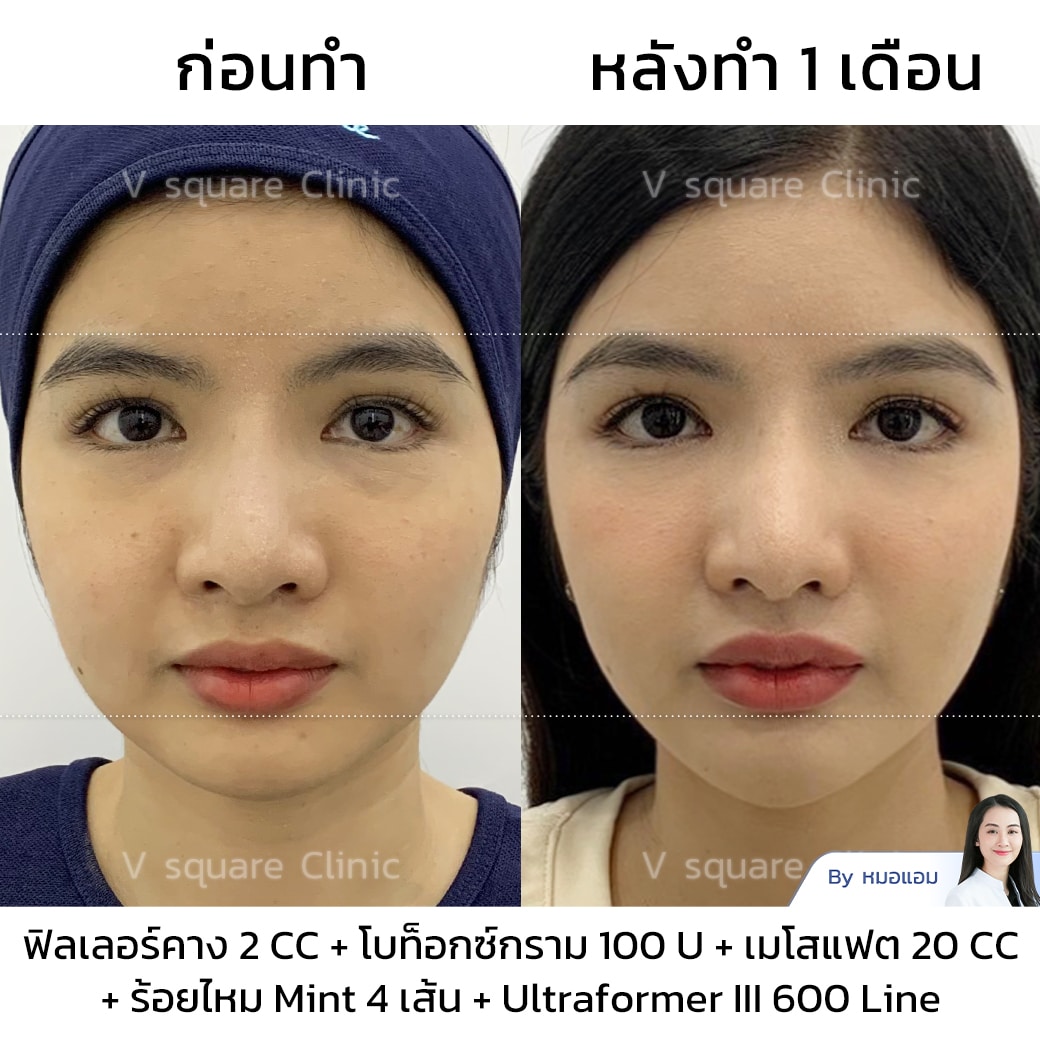 รีวิวโบท็อกลดกราม_คุณซานตี้_Influencer_(คอนเทนต์หน้าเรียว)