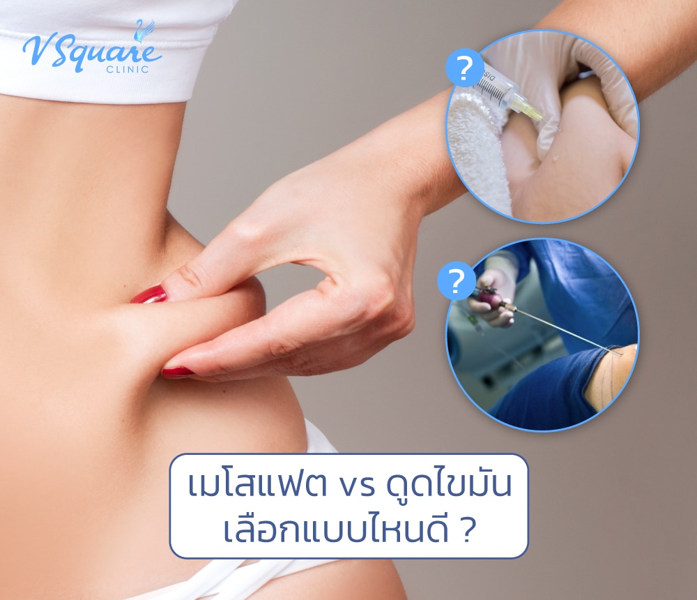 เมโสแฟตกับดูดไขมัน
