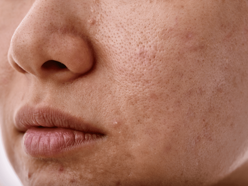 Niacinamide เหมาะกับใคร