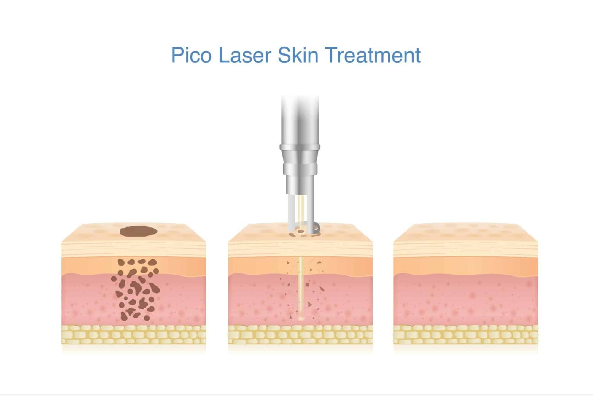 Pico Laser หลักการทำงาน