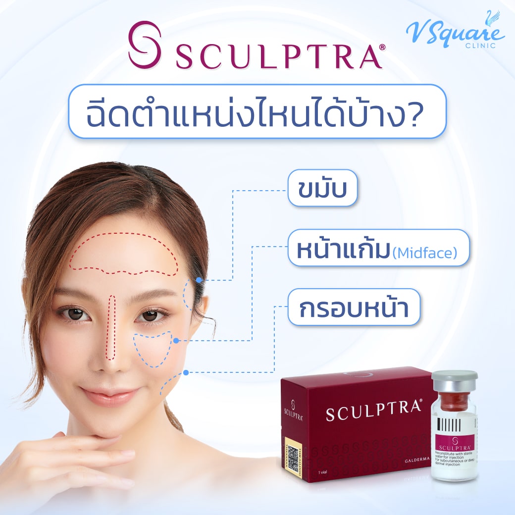 Sculptra ฉีดตรงไหนได้บ้าง