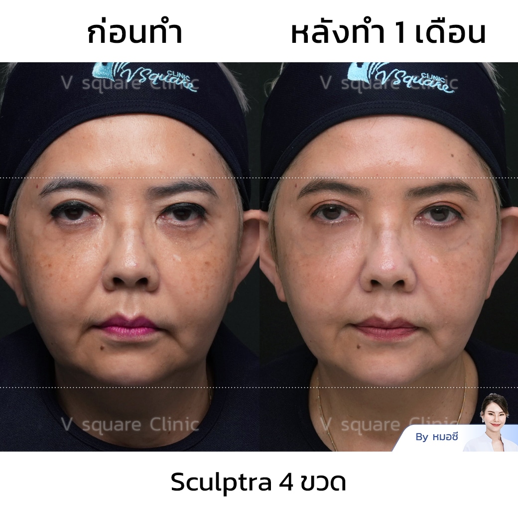 Sculptra รีวิว 4 ขวด_พี่ยุ้ย Sculptra