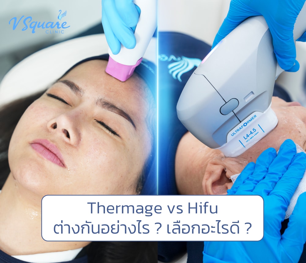 Thermage vs Hifu