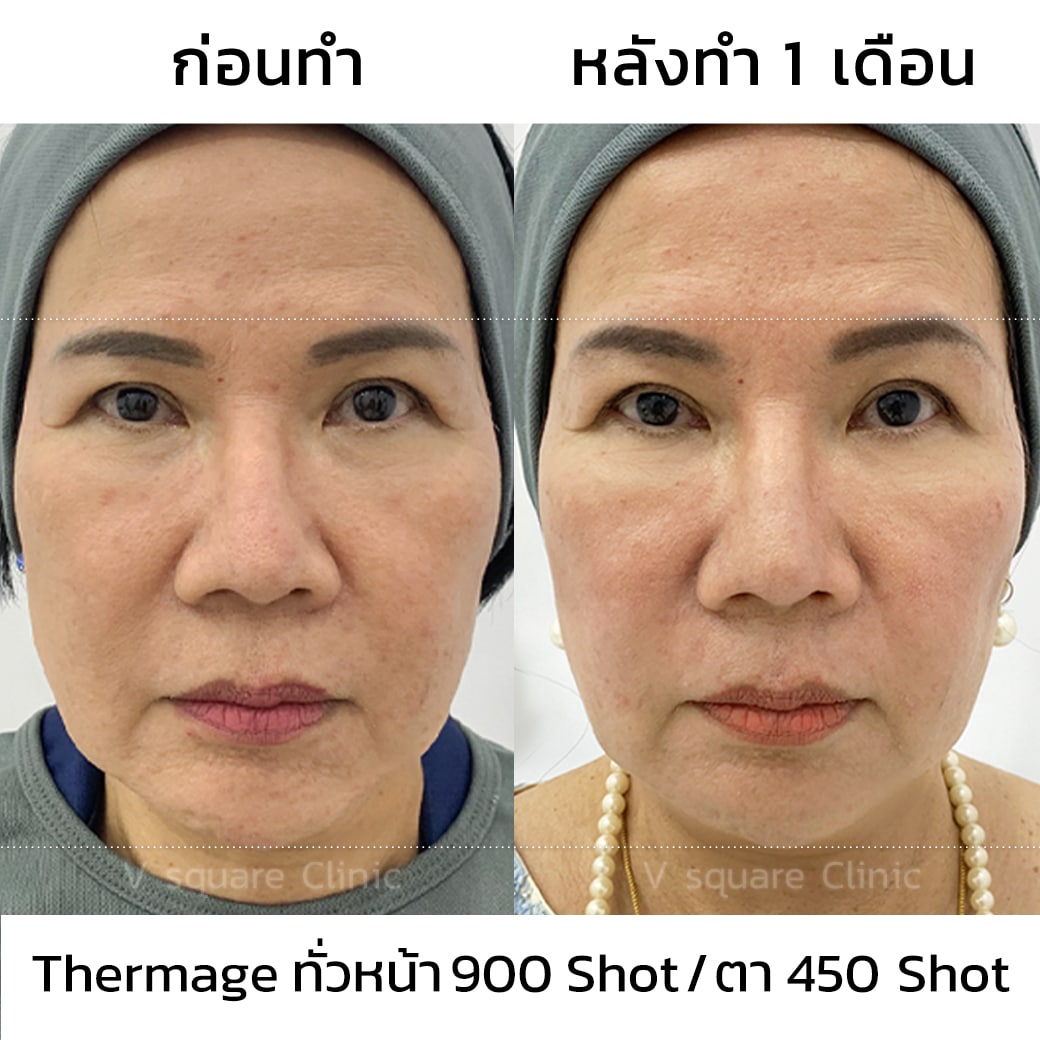 Thermage รีวิว_แม่อ๋อย