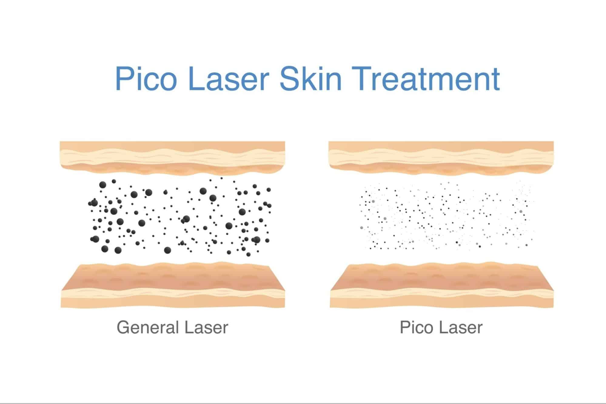 การทำงานของ Pico laser