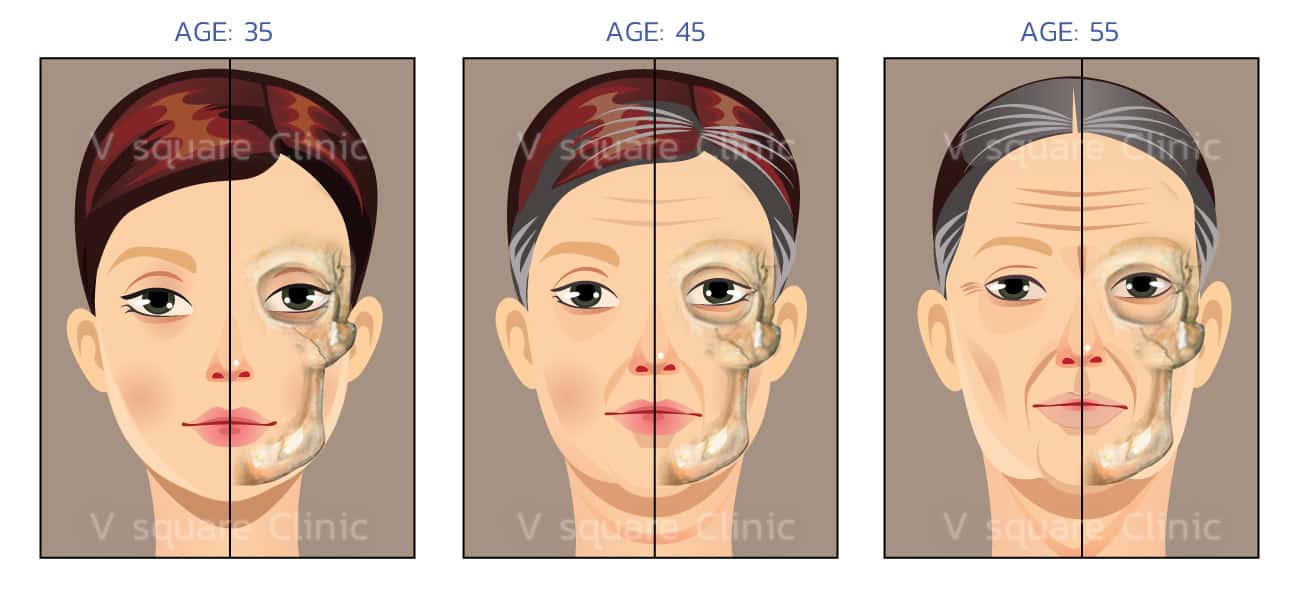 การยุบตัวของโครงหน้า