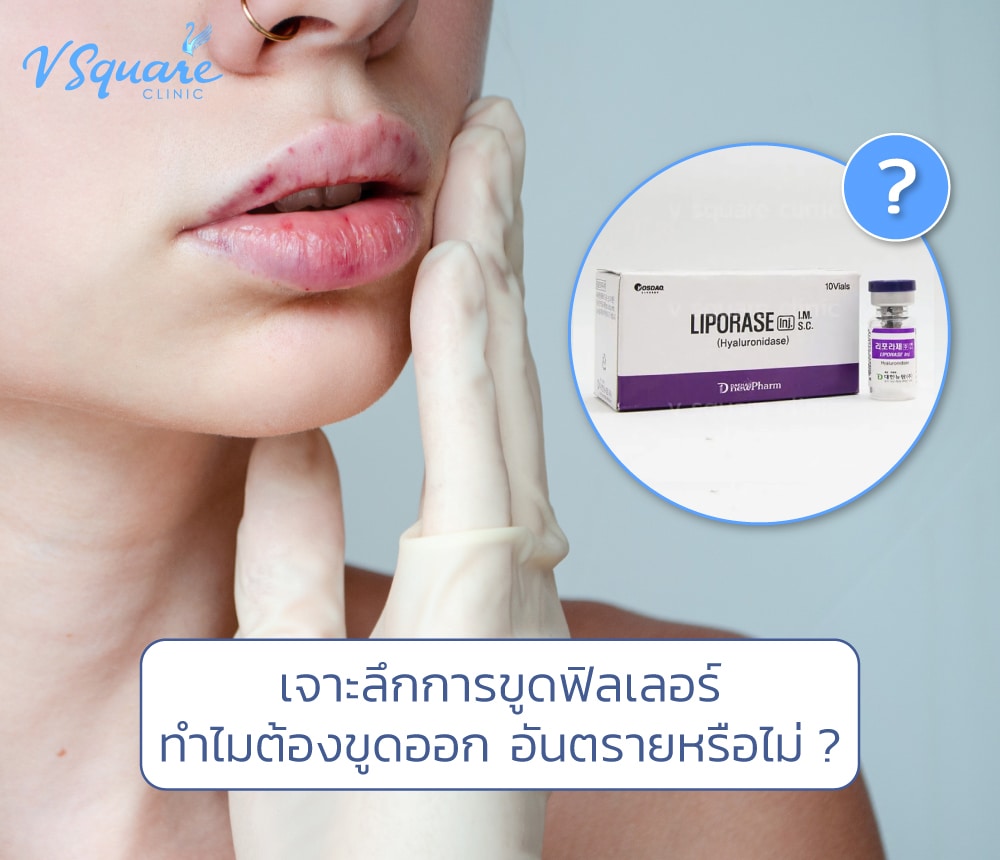 ขูดฟิลเลอร์