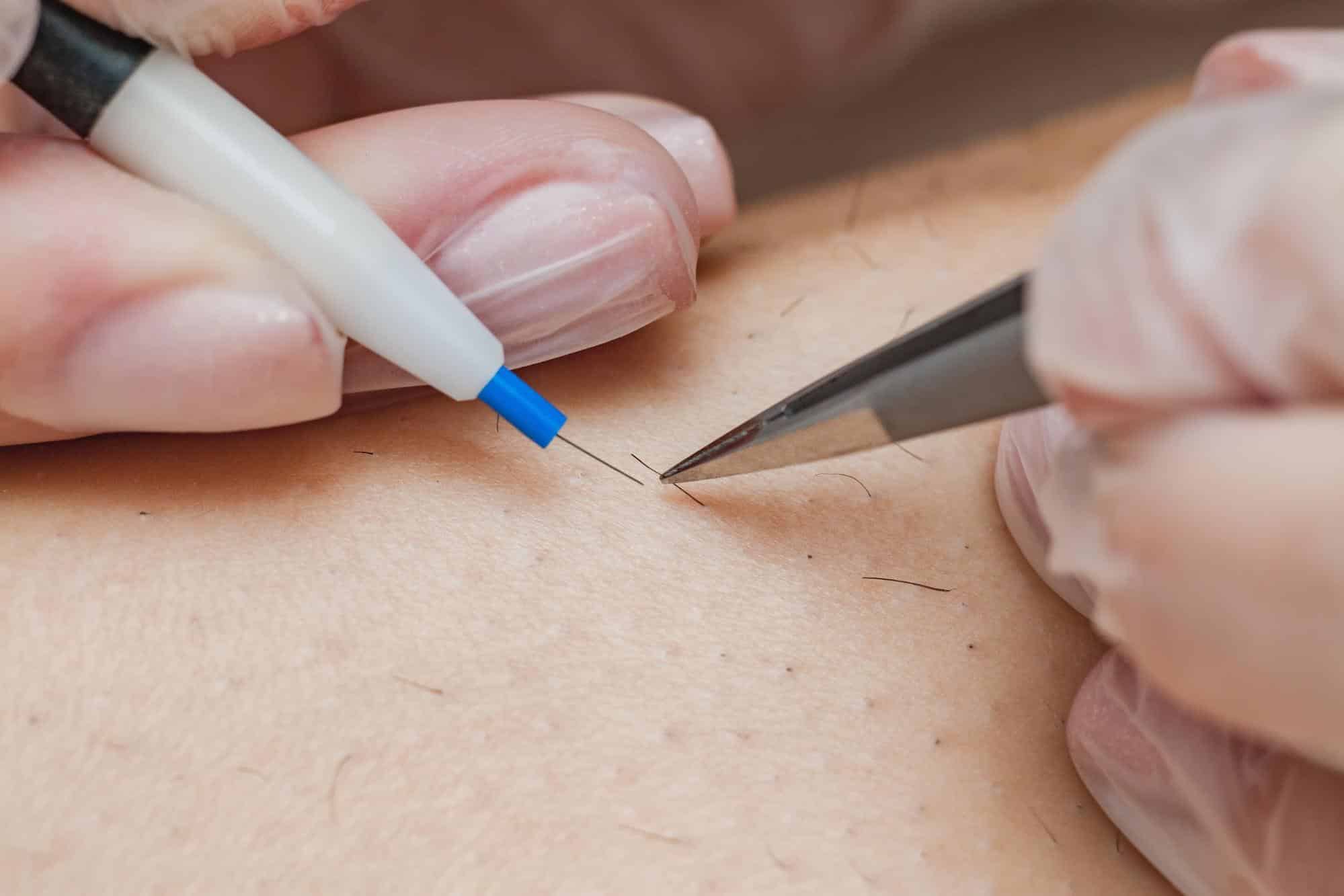 จี้ไฟฟ้ากำจัดขน