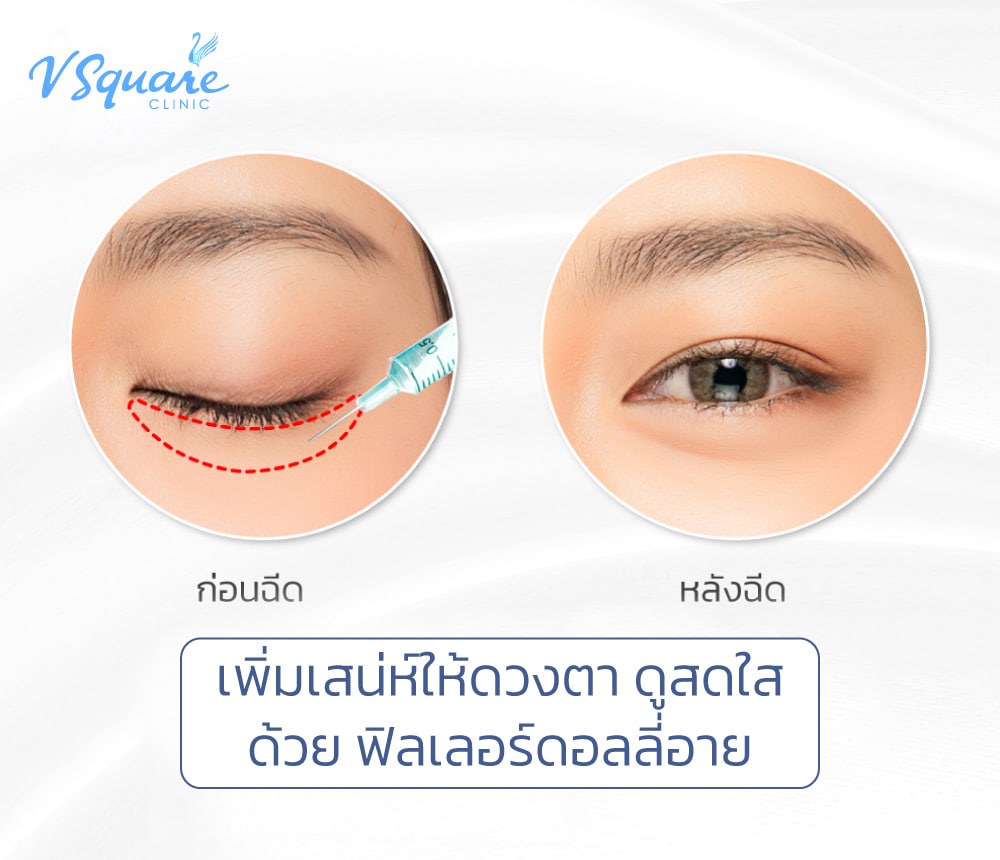 ฉีดดอลลี่อาย