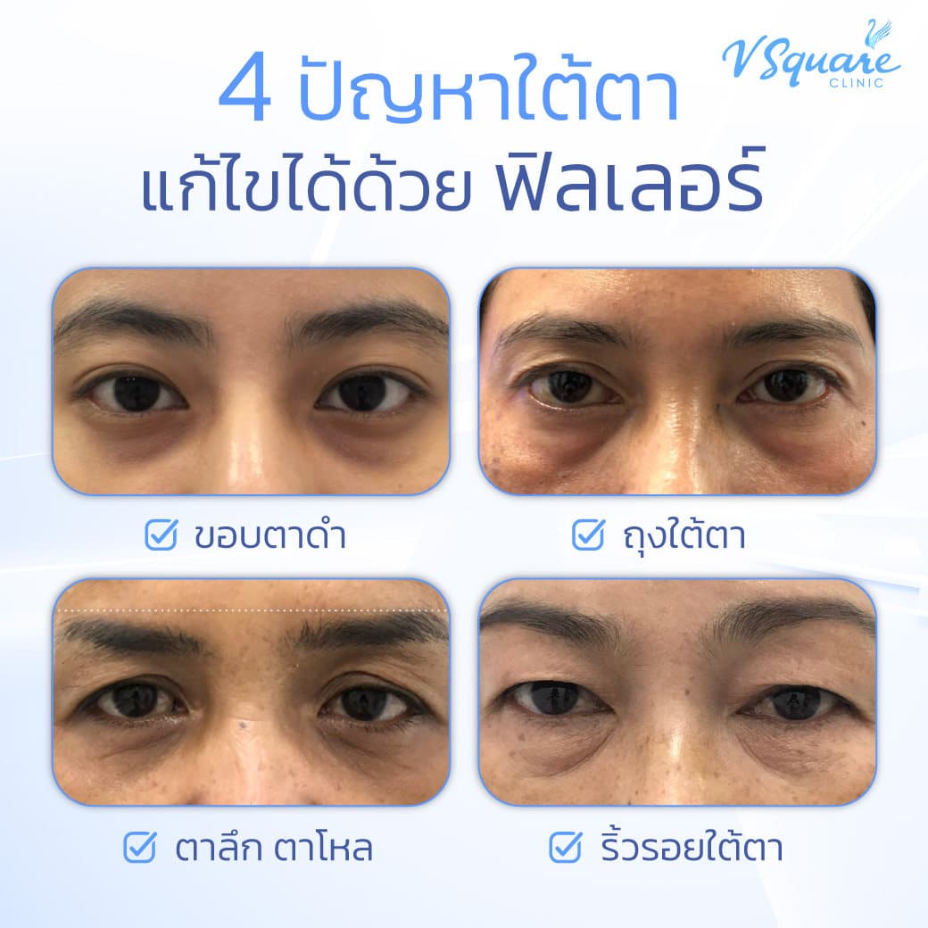 ฉีดฟิลเลอร์ใต้ตา ช่วยแก้ปัญหาอะไร