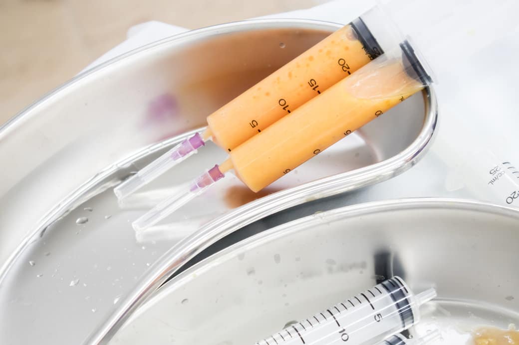 ฉีดไขมัน ดอลลี่อาย