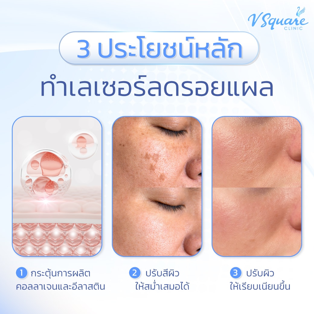 ประโยชน์เลเซอร์รอยแผล