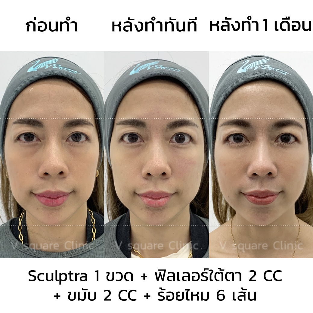 รีวิว Sculptra_คุณเกรซ