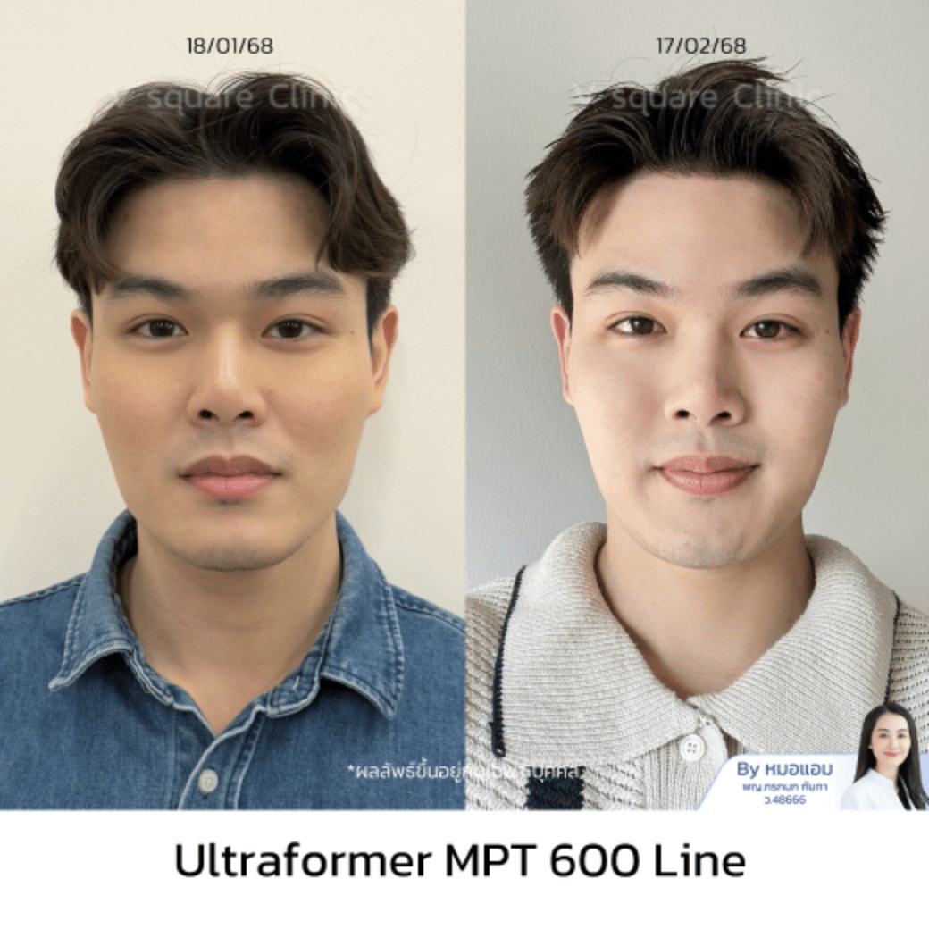 รีวิว hifu_ทอย