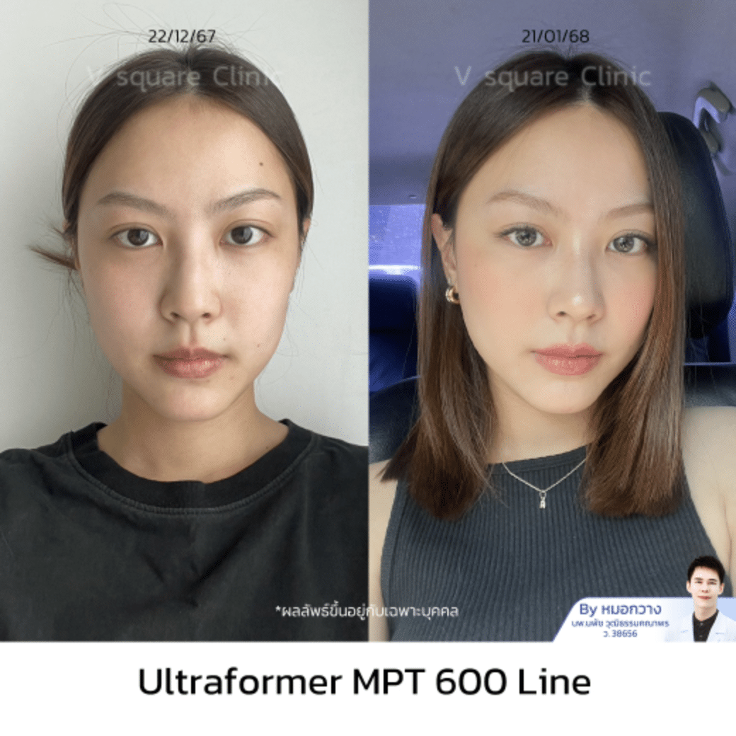 รีวิว hifu_นิว