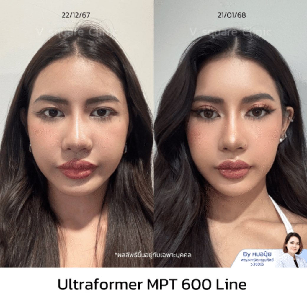 รีวิว hifu_บินนี่