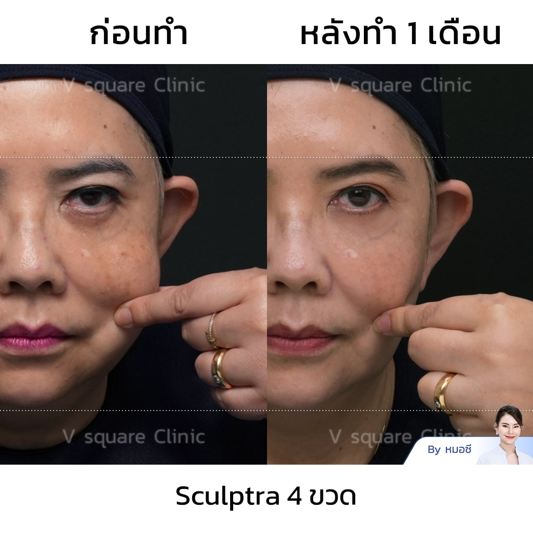 รีวิวฉีด Sculptra 4 ขวด_พี่ยุ้ย Sculptra