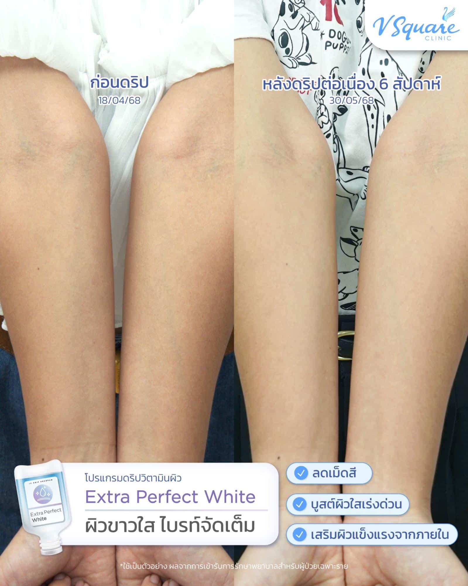 รีวิวดริปวิตามินผิวขาว