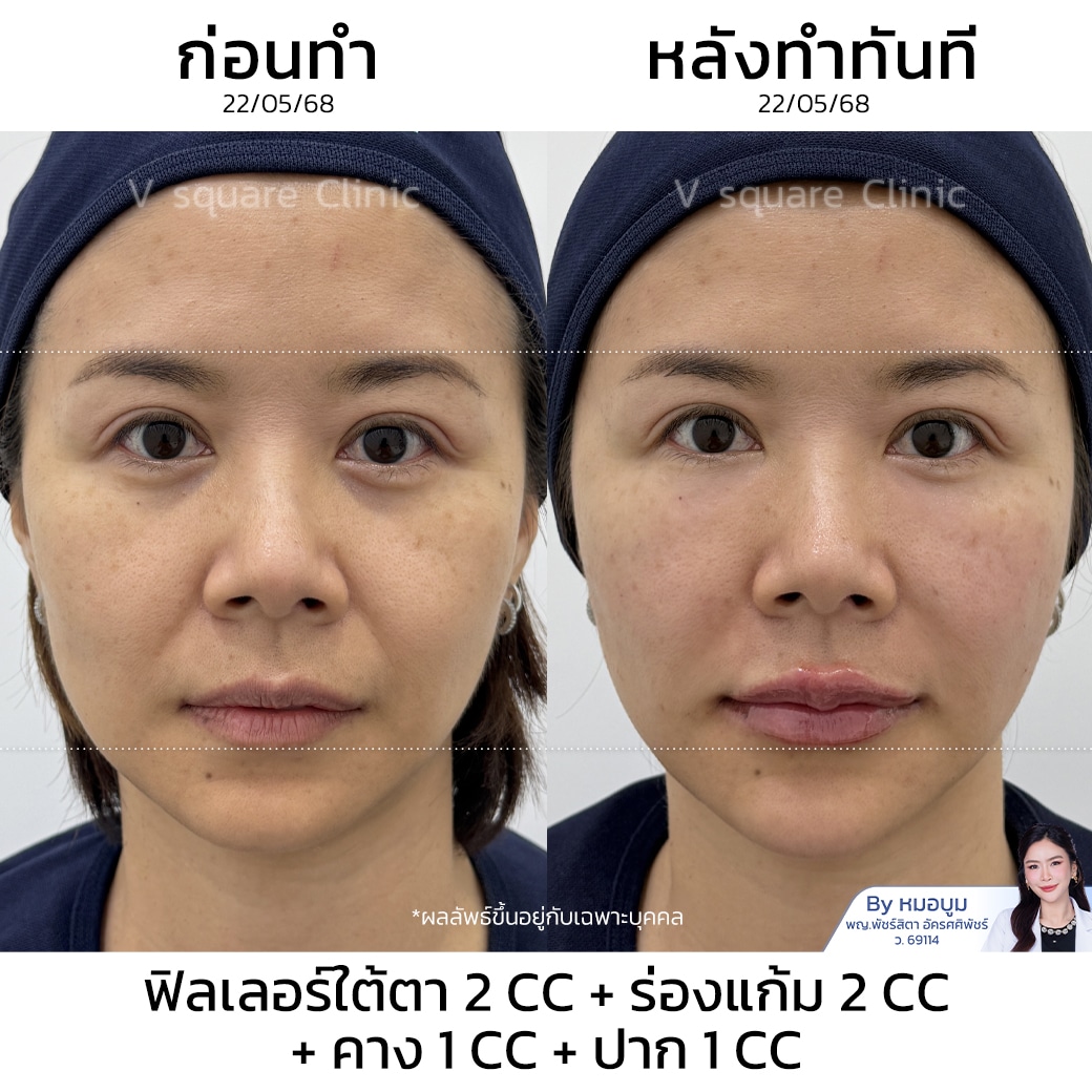 รีวิวฟิลเลอร์ยกหน้า_คุณหญิง