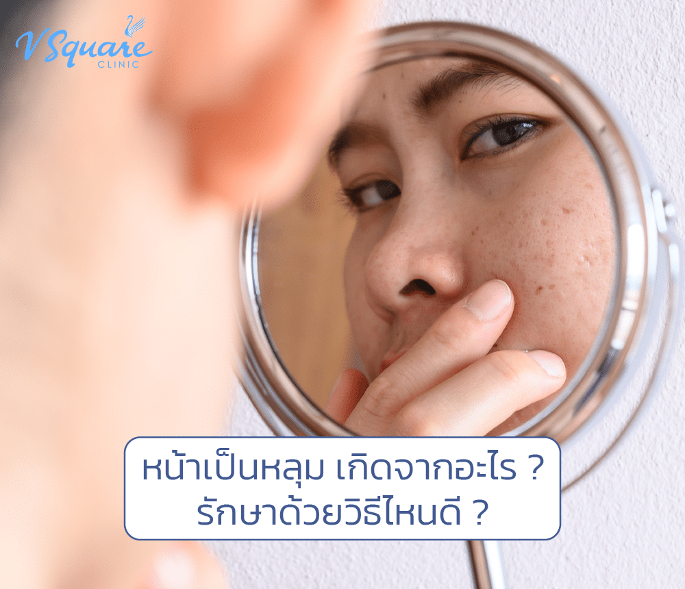 หน้าเป็นหลุม
